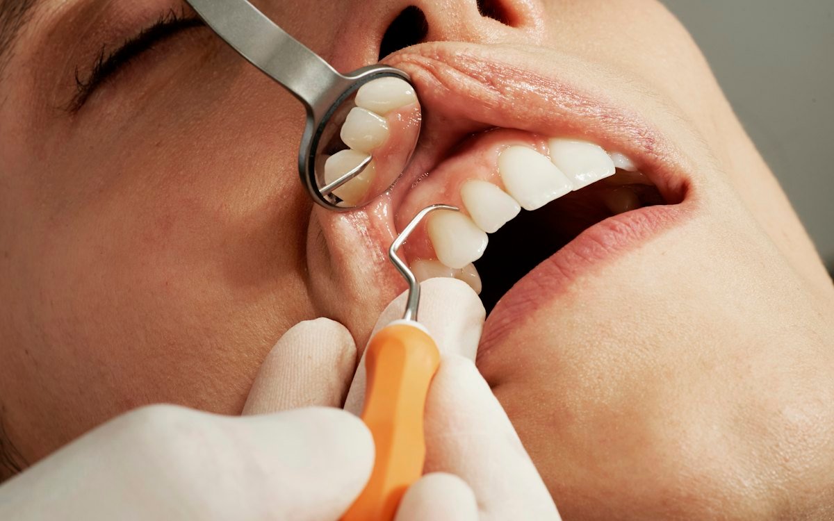 Depois: resultado do tratamento de implantes