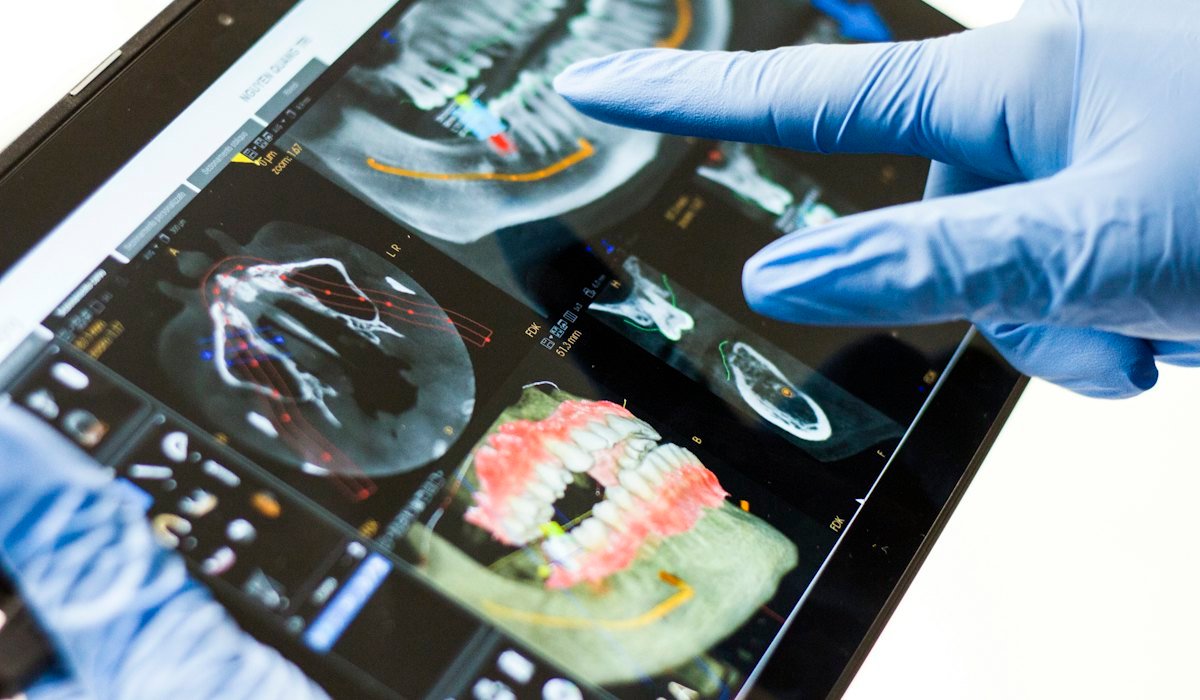 Implantes dentários: guia completo para quem vai começar o tratamento